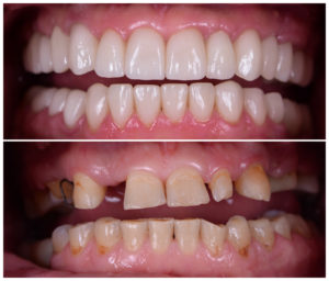 dental implant before and after