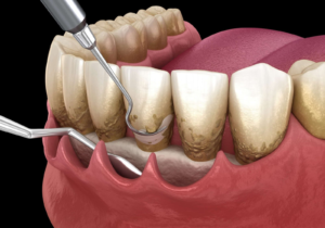 Illustration of periodontal scaling to remove plaque below the gumline.
