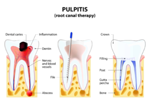 Diagram of the root canal treatment process.