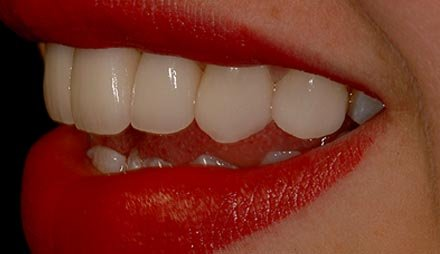 After cosmetic dentistry showing bright, even front teeth.
