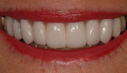 After cosmetic dentistry showing restored upper teeth.