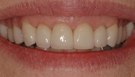 After cosmetic dentistry showing restored lower teeth.