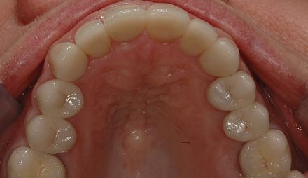 After smile makeover showing a natural-looking restored smile.
