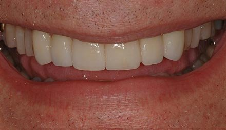 After veneers showing smooth, white front teeth.