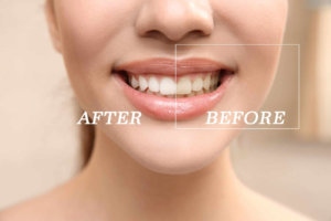 Comparison of tooth color before and after professional teeth whitening treatment on a patient's front teeth.