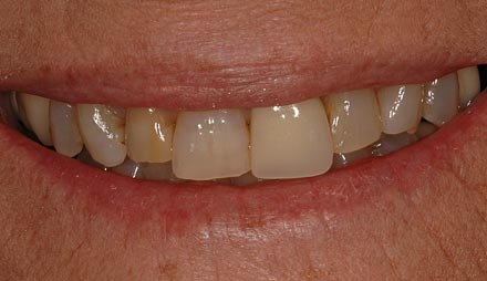 Before cosmetic dentistry showing upper teeth with worn fillings and discoloration.