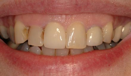 Before cosmetic dentistry showing lower teeth with worn fillings.