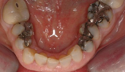 Side view before cosmetic dentistry showing stained front teeth.