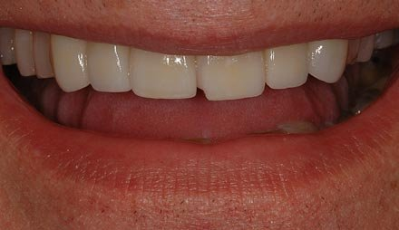Before veneers showing stained and chipped front teeth.