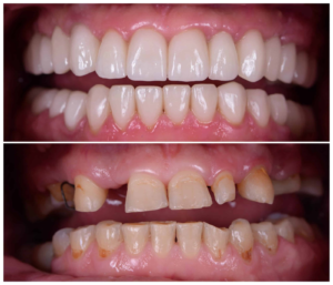 Comparison of multiple missing teeth replaced with dental implants and natural-looking restorations.