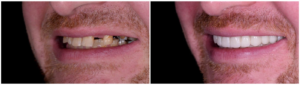 Comparison showing front teeth restored with dental implants after missing tooth replacement.